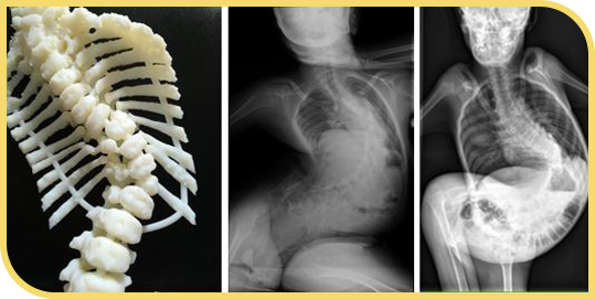 Causas de la escoliosis