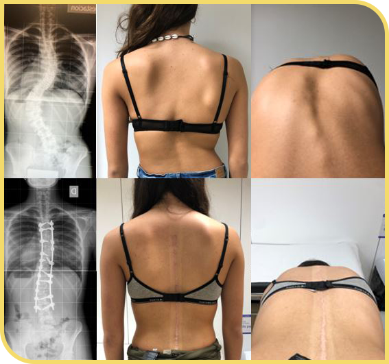 Cirugía de escoliosis en casos graves