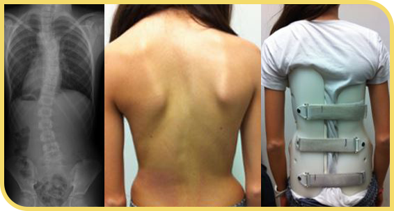 Corsé para tratar la escoliosis idiopática en adolescentes