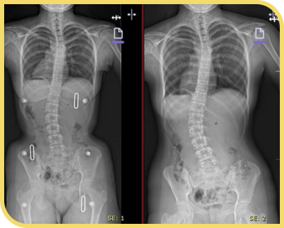 Corsés ortopédicos escoliosis
