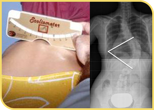 Diagnóstico de la escoliosis