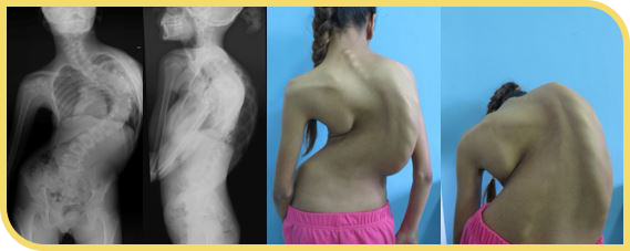 Escoliosis grave de adolescente