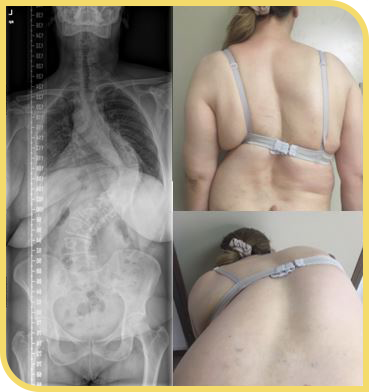 Escoliosis idiopática del adulto