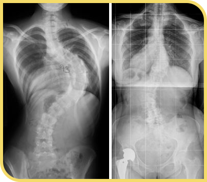 Escoliosis idiopática