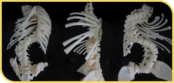 Impresión en 3D de una escoliosis grave adolescente