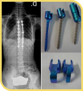 Instrumentación para corregir la escoliosis