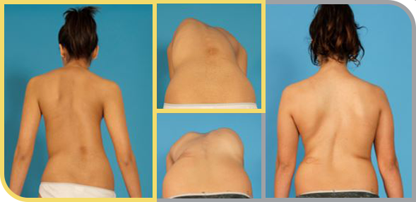 Síntomas de la escoliosis