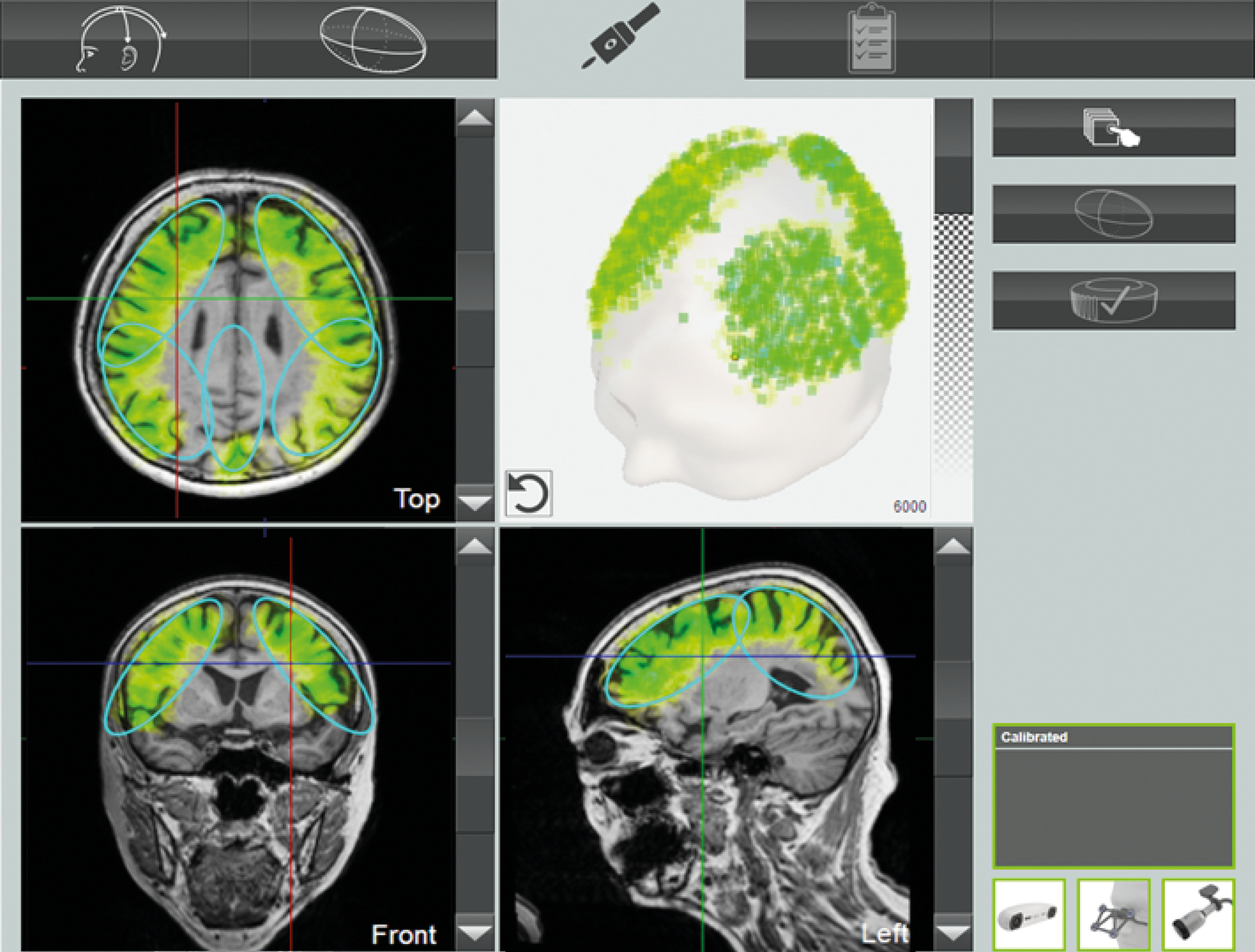 Ondas de choque para el tratamiento del Alzheimer - clínica DKF