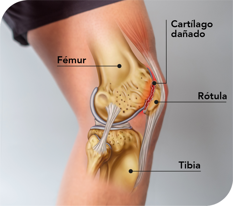 Condromalacia rotuliana en Clínica DKF