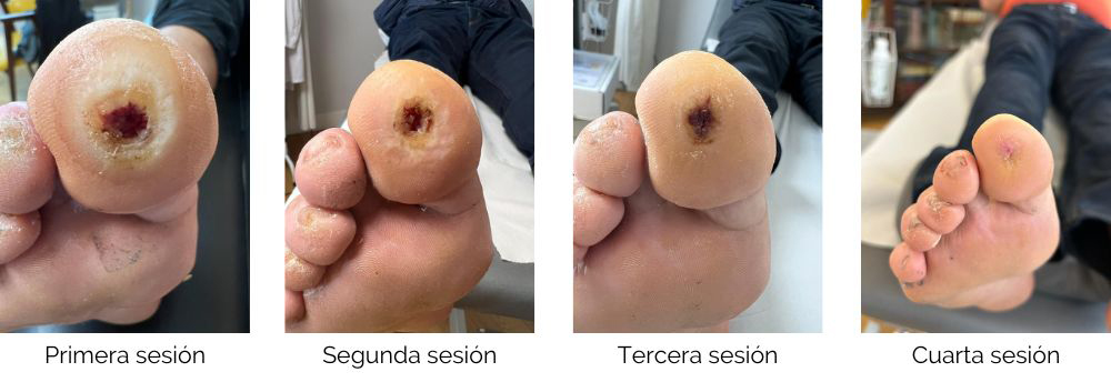Evolución de úlcera de pie diabético con tratamiento de ondas de choque cutáneas